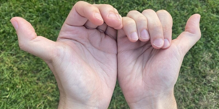 The health risks of being double-jointed