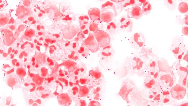 Photomicrograph of Neisseria meningitidis, the bacteria that can lead to invasive meningococcal disease, in spinal fluid.