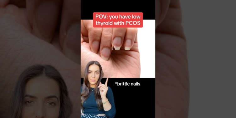 Signs of low thyroid with #pcos