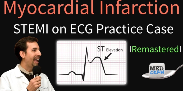 Myocardial Infarction / STEMI on ECG - Practice EKG