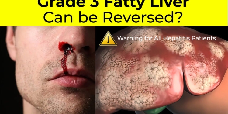 Fatty Liver Grade 3 Symptoms | Grade 3 Fatty Liver Treatment | Fatty Liver | Hepatitis