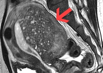 All you need to know about: adenomyosis