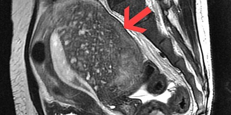 All you need to know about: adenomyosis