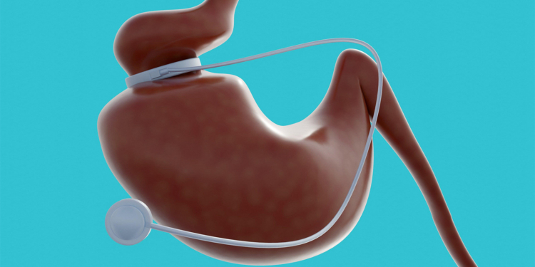 Call to Integrate Obesity Management With Surgery, GLP-1s Into Cancer Care