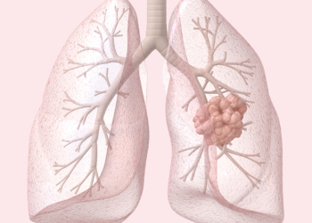 Early Lung Cancer Data Show Why FDA Approved HER2 Agent in First-Line