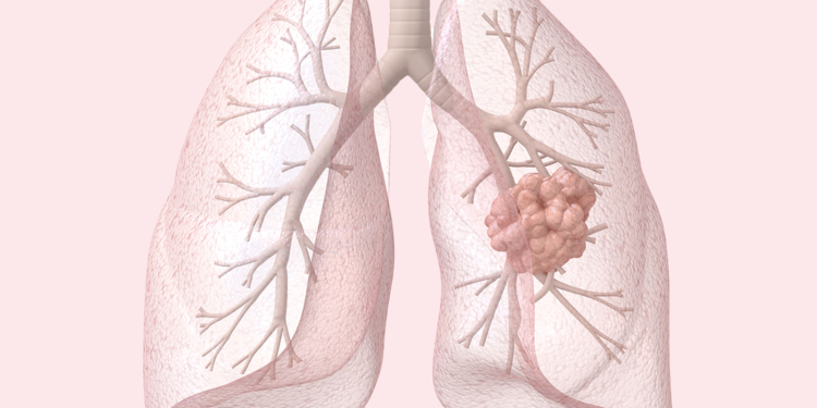 Early Lung Cancer Data Show Why FDA Approved HER2 Agent in First-Line