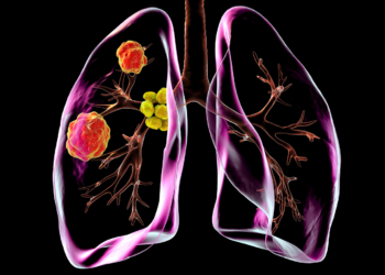 High Rate of Surgical Success in Complex NSCLC With Neoadjuvant Chemoimmunotherapy