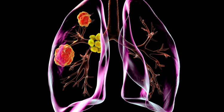 High Rate of Surgical Success in Complex NSCLC With Neoadjuvant Chemoimmunotherapy