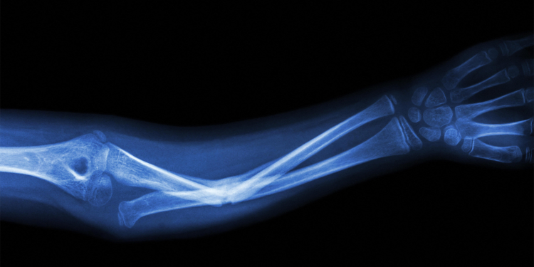 Large GLP-1 Drug Review Takes Closer Look at Risks, Rewards