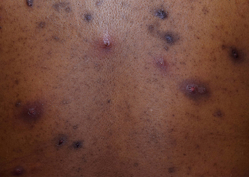 Make the Diagnosis: Is This Eruption Related to the Patient's Acne? His Ulcerative Colitis?