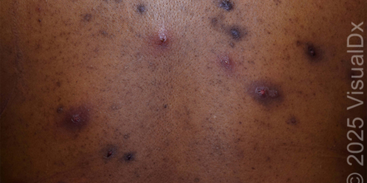 Make the Diagnosis: Is This Eruption Related to the Patient's Acne? His Ulcerative Colitis?