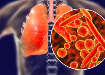 Mycoplasma Pneumonia Recovery Faster With Corticosteroid