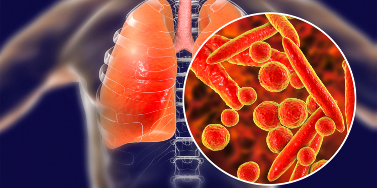 Mycoplasma Pneumonia Recovery Faster With Corticosteroid