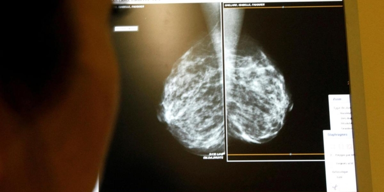 Nearly 13% of women in India with breast cancer experienced metastasis: Study