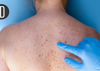 Novel Therapies for Hidradenitis Suppurativa Produce Rapid, Deepening Responses