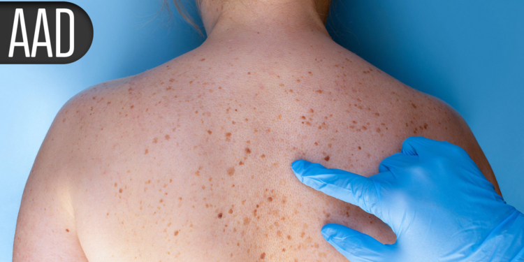 Novel Therapies for Hidradenitis Suppurativa Produce Rapid, Deepening Responses