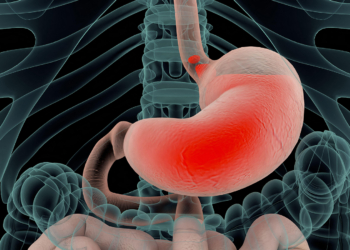 Strategy Reduces Inappropriate Proton Pump Inhibitor Use