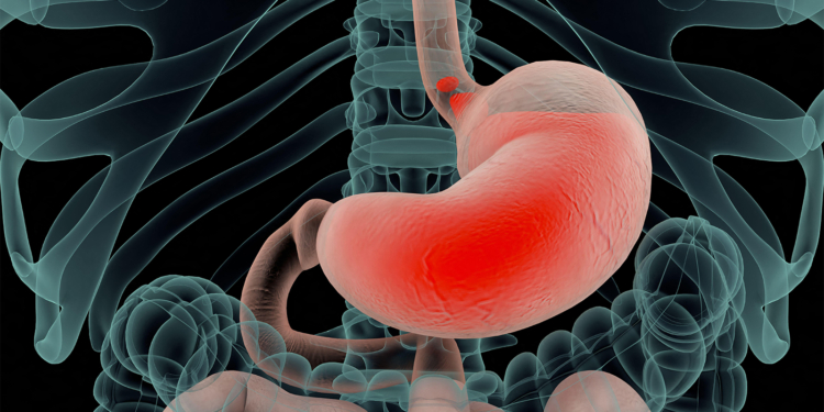 Strategy Reduces Inappropriate Proton Pump Inhibitor Use