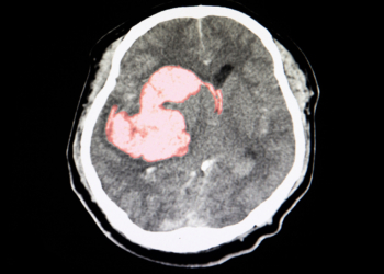 Triple Pill Gets Intracerebral Hemorrhage Survivors Closer to BP Goals
