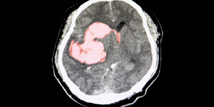 Triple Pill Gets Intracerebral Hemorrhage Survivors Closer to BP Goals