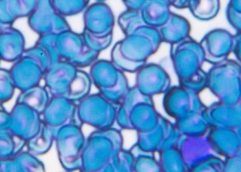 What the study of the mutant gene behind aggressive adult leukaemia can offer for treatment