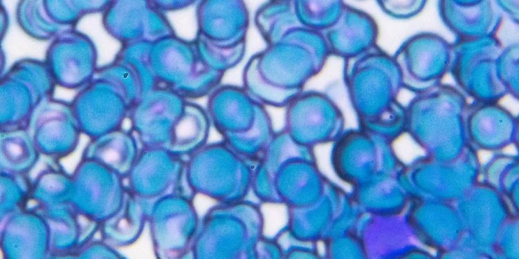 What the study of the mutant gene behind aggressive adult leukaemia can offer for treatment