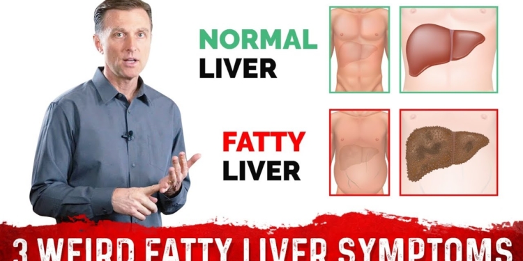 3 Weird Signs & Symptoms Of Fatty Liver – Dr.Berg