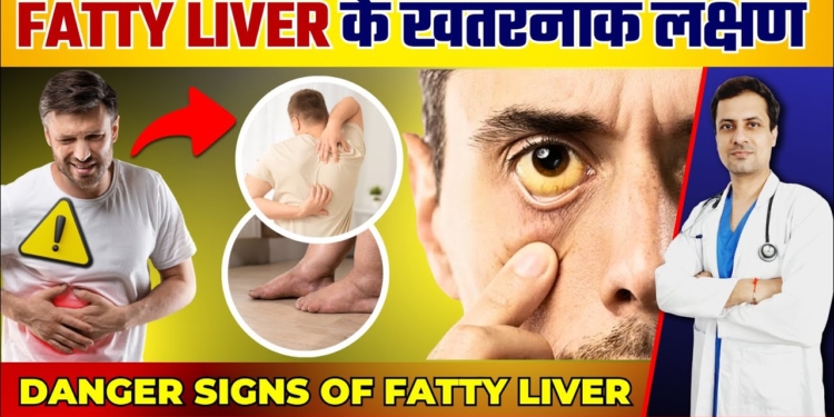 Danger Signs of Fatty Liver | FATTY LIVER KE LAKSHAN in Hindi | Fatty Liver symptoms