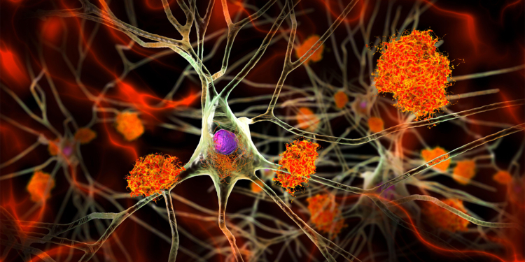 Alzheimer's Signs Hidden in Midlife Brains, Study Shows