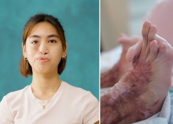 Belo performs first-ever facial bone reconstruction using custom 3D-printed implant in landmark scar project case