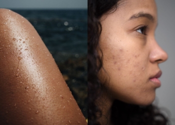Doctor shares skincare tips for sunburn, acne, fungal infection
