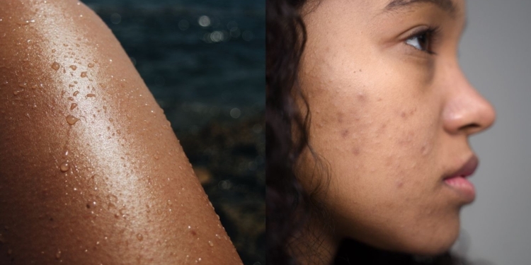Doctor shares skincare tips for sunburn, acne, fungal infection