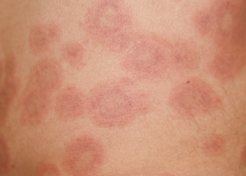 Drug Targeting TLRs in Cutaneous Lupus Looks Good in Mid-Stage Studies