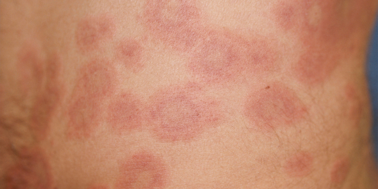 Drug Targeting TLRs in Cutaneous Lupus Looks Good in Mid-Stage Studies