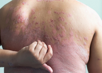 GLP-1 Drug Makes Its Case for Treating Plaque Psoriasis