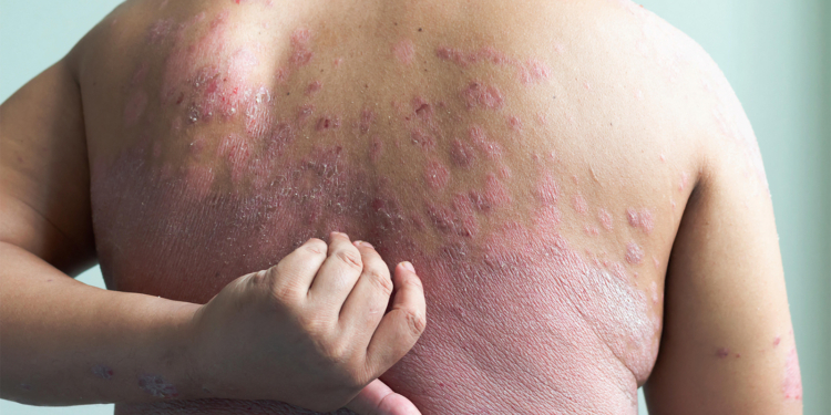 GLP-1 Drug Makes Its Case for Treating Plaque Psoriasis
