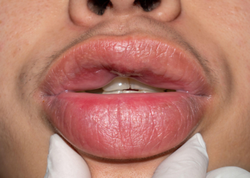 Hereditary Angioedema: Epidemiology and Prevalence