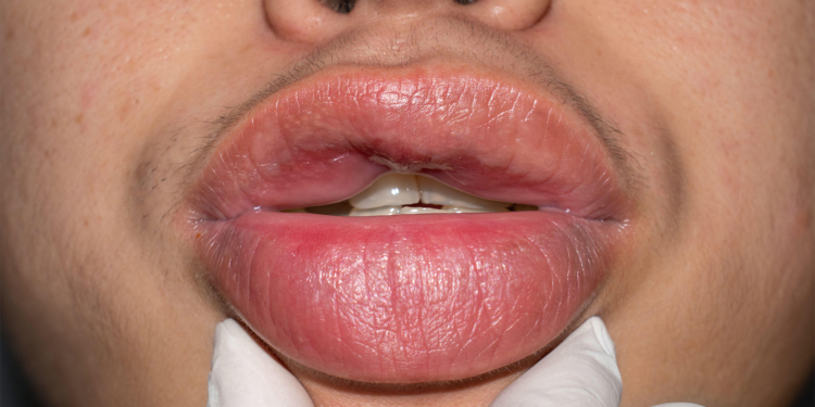 Hereditary Angioedema: Epidemiology and Prevalence