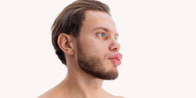 Hereditary Angioedema Prophylaxis: Persistence and Adherence