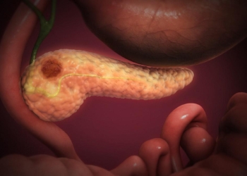 Hope for pancreatic cancer as new drug, daraxonrasib, shows promise