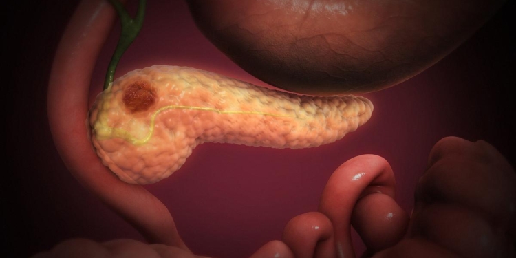 Hope for pancreatic cancer as new drug, daraxonrasib, shows promise