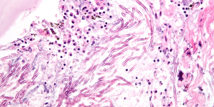 India still short on expertise, tools to manage fungal health burden
