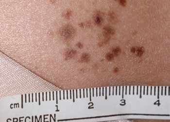 Make the Diagnosis: This Is a Curious Cluster. Can You Diagnose It?
