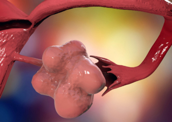 New Name for PCOS More Accurately Reflects Condition