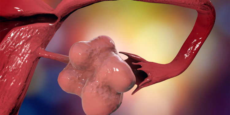 New Name for PCOS More Accurately Reflects Condition