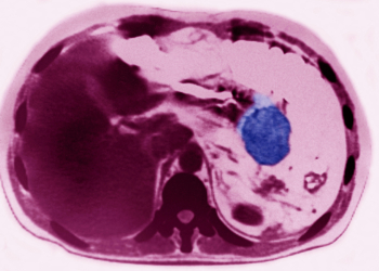 Pancreatic Cancer Risk Much Higher for Certain Group, Study Suggests