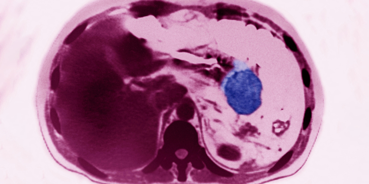 Pancreatic Cancer Risk Much Higher for Certain Group, Study Suggests