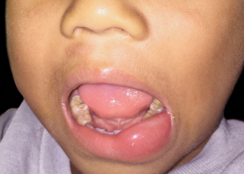 Pediatric Hereditary Angioedema Treatment Options Growing