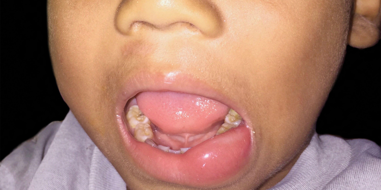 Pediatric Hereditary Angioedema Treatment Options Growing