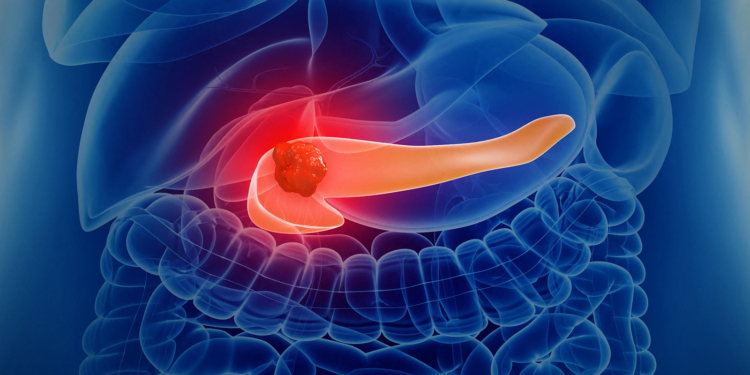 Safety Data on the Novel Pancreatic Cancer Drug Available by Early Access
